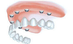 Illustration of an All-on-Eight implant-supported denture being placed in the lower jaw by Premier Holistic Dental in London.