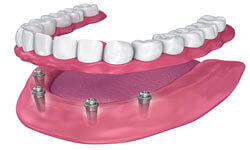 Illustration of an All-on-Four  implant-supported denture being placed in the lower jaw by Premier Holistic Dental in London.