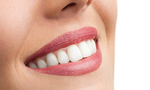 Close-up picture of a smiling happy woman with perfect teeth, showing her happiness with her All-on-Six implant-supported denture  she had made in Costa Rica.