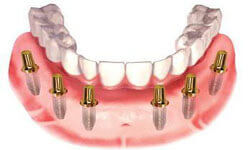 Illustration of an All-on-Six implant-supported denture being placed in the lower jaw by Premier Holistic Dental in London.