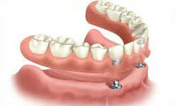 Illustration of an All-on-Two implant-supported denture being placed in the lower jaw by Premier Holistic Dental in London.