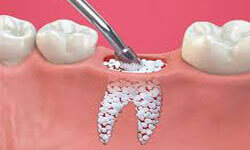 Illustration of a dental bone graft procedure in the lower jaw by Premier Holistic Dental in London.
