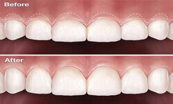 Illustration of a crown lengthening procedure in the upper jaw by Premier Holistic Dental in London.