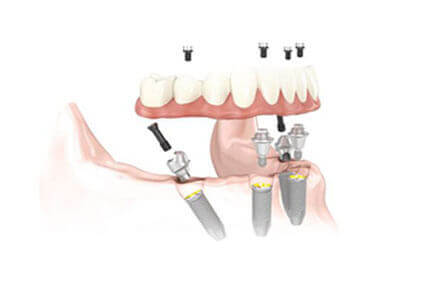 Illustration of an all-on-four procedure done in Costa Rica.
