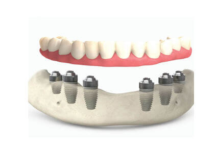 Illustration of an all-on-six procedure done in Costa Rica.