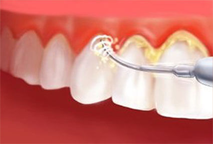 Illustration of a dental cleaning procedure in Costa Rica.