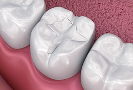 Illustration of a dental fillings procedure in Costa Rica.