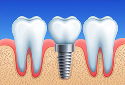 Illustration of a Holistic Dental Implant being placed in the lower jaw by Premier Holistic Dental in London.