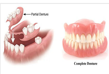 Illustration of a dentures procedure in Costa Rica.