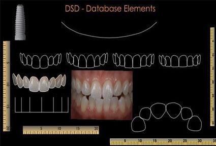 Illustration of a dental digital smile design (DSD), showing how it is  done in Costa Rica.