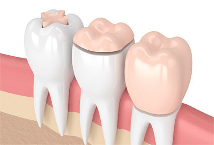 Illustration of how a dental inlay and onlay procedure is done in Costa Rica.  The picture shows 3 teeth in the lower jaw, one with an inlay, one with an only, and one with a dental crown.