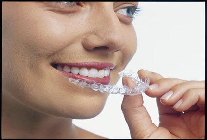 Illustration of an Invisalign procedure done in Costa Rica.