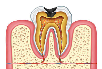 Illustration of a tooth in the lower jaw, showing how an oral surgery procedure is done in Costa Rica.