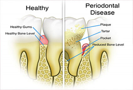 Illustration of a periodontal procedure in Costa Rica.