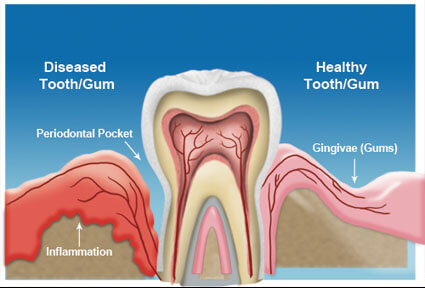 Illustration of a tooth in the lower jaw, showing how a periodontics procedure is done in Costa Rica.