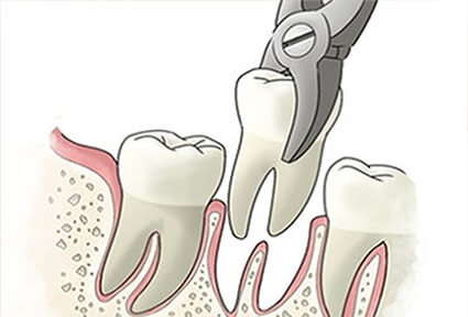 Illustration of a dental extractions procedure in Costa Rica.