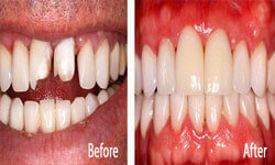 Picture of the upper and lower teeth showing a dental crowns procedure by Premier Holistic Dental in London.