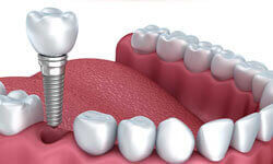 Illustration of a Holistic Dental Implant being placed in the lower jaw by Premier Holistic Dental in London.