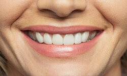 Close-up picture of a smiling woman with perfect teeth, happy with her new dentures by Premier Holistic Dental in London.