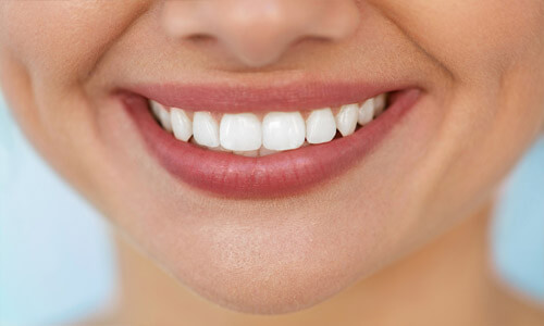 Close up picture of a smiling woman with white perfect teeth showing her happiness with the implant supported bridge she received in San Jose, Costa Rica.