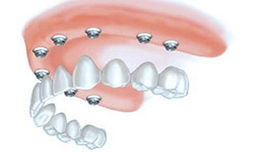 Illustration of an all-on-eight implant-supported denture made in Costa Rica.  The illustration shows how the denture is attached to the implants.