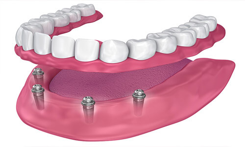 Illustration of an all-on-four implant-supported denture made in Costa Rica.  The illustration shows how the denture is attached to the implants.