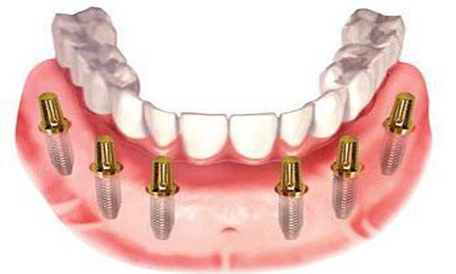 Illustration of an all-on-six implant-supported denture made in Costa Rica.  The illustration shows how the denture is attached to the implants.