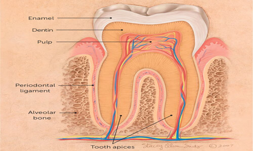 Illustration of a dental Cavitation procedure. The illustration shows a cross section of a tooth and where a cavitation can occur.