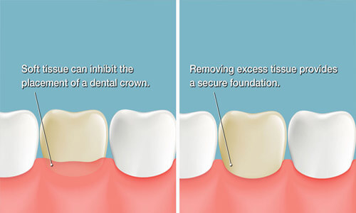 Illustration of a 3 teeth needing a scaling and root planing procedure in Costa Rica. The illustration shows how the lower part of the tooth is scraped to remove plaque.