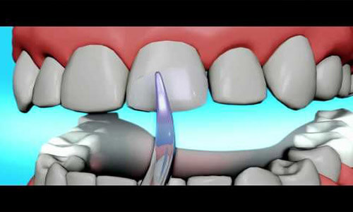 Illustration of a front chipped tooth repaired with dental bonding.   The illustration shows the upper and lower teeth and how a bonding procedure is done