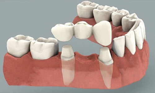 Illustration of a dental bridge showing how it is placed on adjoining teeth.  The teeth are white and the illustration shows the lower teeth.