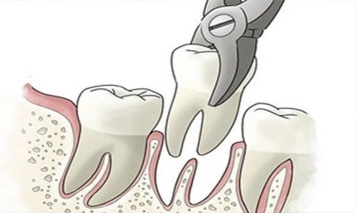 Illustration of a dental tooth extraction procedure.  The illustration shows 3 teeth on the lower jaw, with one being extracted with a dental tool.