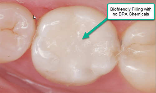 Illustration of a Holistic dental bonding using no BPA chemicals. The illustration shows 3 lower teeth with the filling material applied to the center of the middle tooth.