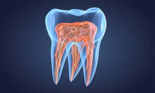Illustration of a tooth showing an Endodontics procedure.  The illustration shows the inner structure and roots of a tooth.