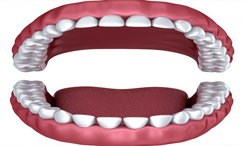 Illustration of a dental full mouth makeover as done in San Jose, Costa Rica.  The illustration shows an open mouth will all of the teeth on both the upper and lower arches visible.