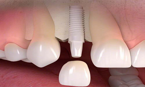 Illustration of a white ceramic holistic dental implant and zirconia crown.  The illustration shows how the crown is attached to the implant.