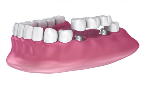 Illustration of an implant supported bridge as made in San Jose, Costa Rica.  The illustration shows the lower teeth with a 3 unit bridge being attached to two implants.