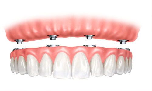 Illustration of an implant supported denture as made in San Jose, Costa Rica.  The illustration shows the upper denture being attached with four implants