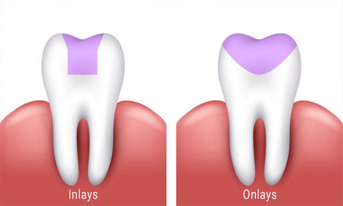 Illustration of a front chipped tooth repaired with dental bonding.   The illustration shows the upper and lower teeth and how a bonding procedure is done.