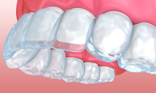Illustration of an Invisalign procedure.  The illustration shows how the aligners fit over the front teeth.