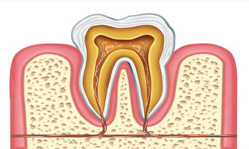 Illustration of a tooth showing an Endodontics procedure.  The illustration shows the inner structure and roots of a tooth.