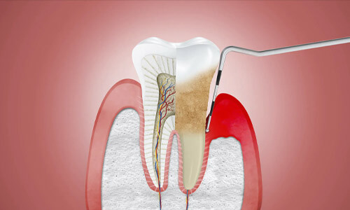 Illustration of a tooth with needing periodontics work.  The illustration shows a dental tool being used to removal periodontal disease.