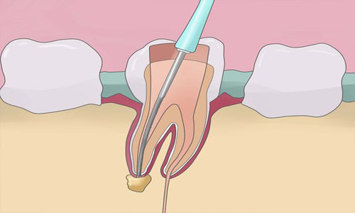 Illustration of a dental root canal procedure.  The illustration shows a cross-section of a tooth with a dental utensil removing infections through a root canal.