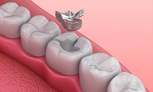 Illustration of a dental tooth depicting a safe mercury removal procedure.  The illustration shows 5 lower teeth with the old mercury filling being removed from the middle tooth.