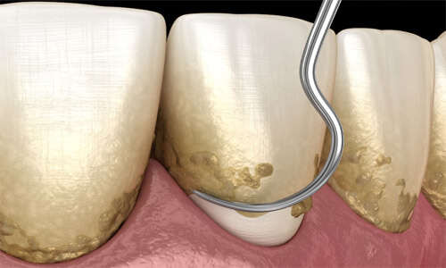 Illustration of a 3 teeth needing a scaling and root planing procedure in Costa Rica. The illustration shows how the lower part of the tooth is scraped to remove plaque.