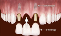 Illustration of an implant-supported bridge procedure in the upper jaw by Premier Holistic Dental in London.