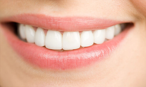 Close up picture of a smiling woman with white perfect teeth showing her happiness with the implant supported denture she received in San Jose, Costa Rica.