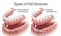 Illustration of an implant-supported dentures procedure in the lower jaw by Premier Holistic Dental in London.