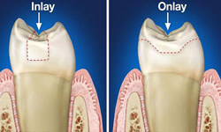 Illustration of an dental inlay and onlay as it is performed in the lower jaw.by Premier Holistic Dental in London.