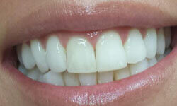 Picture of a smiling woman showing a Invisalign dental procedure by Premier Holistic Dental in London.